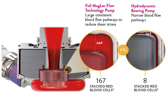 Технологията Full MagLev Flow поддържа нежно боравене с кръвта, за да минимизира усложненията и нежеланите събития, свързани с хемосъвместимостта. Напълно левитиран, самоцентриращ се ротор, който не изисква хидродинамични или механични лагери Големи, постоянни пътища на кръвния поток за намаляване на напрежението на срязване 3 Вътрешна пулсация за намаляване на застоя и минимизиране на тромба 3,4